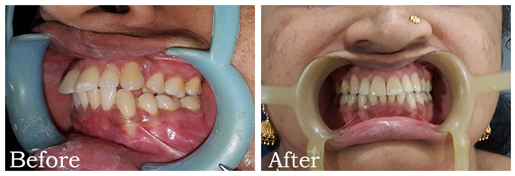 Clear Aligner - Case Study 1