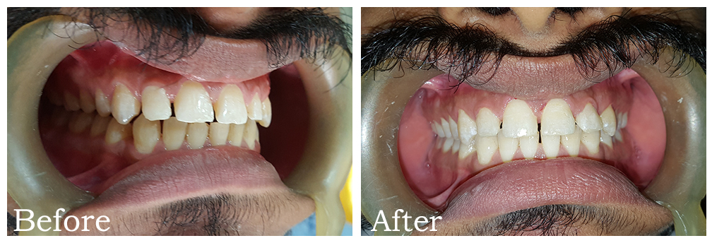 Clear Aligner - Case Study 2