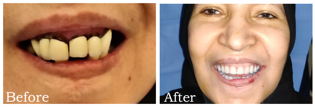 Multiple Teeth Implant 3