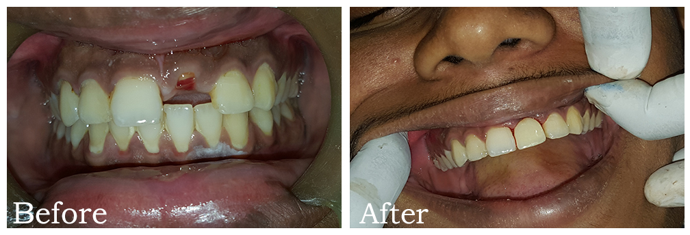 Single Tooth Implant 1