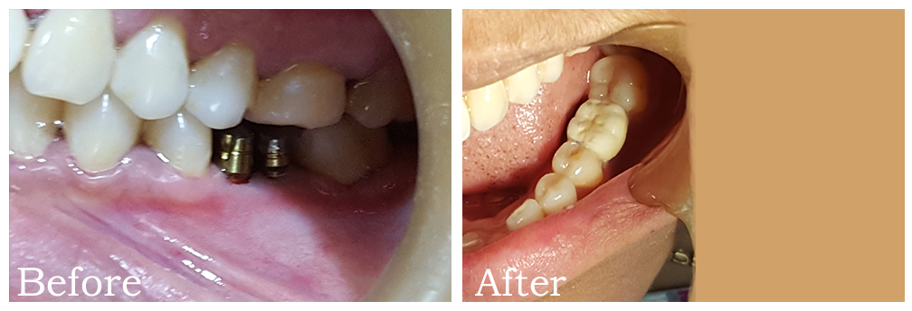 Single Tooth Implant 2