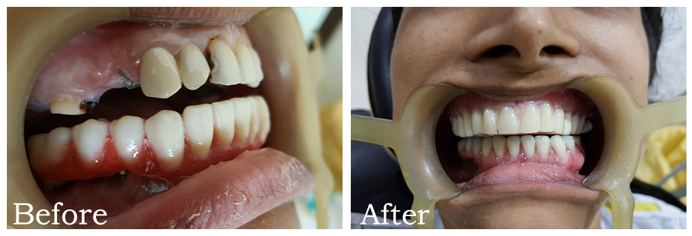 Single Tooth Implant 3